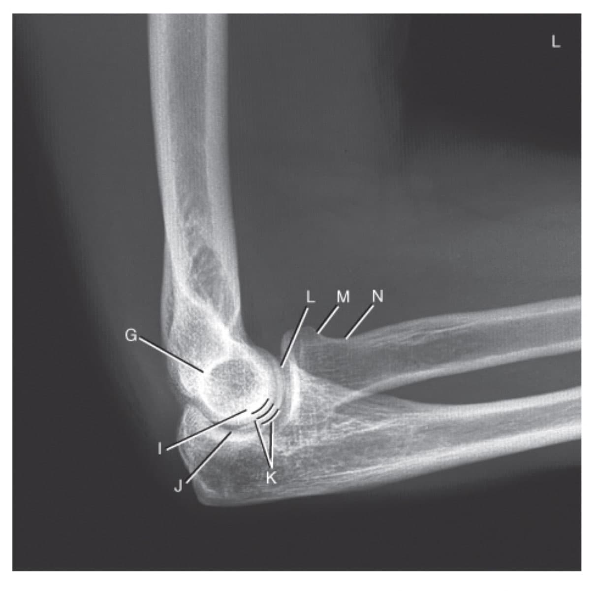 Lateral Elbow X-Ray