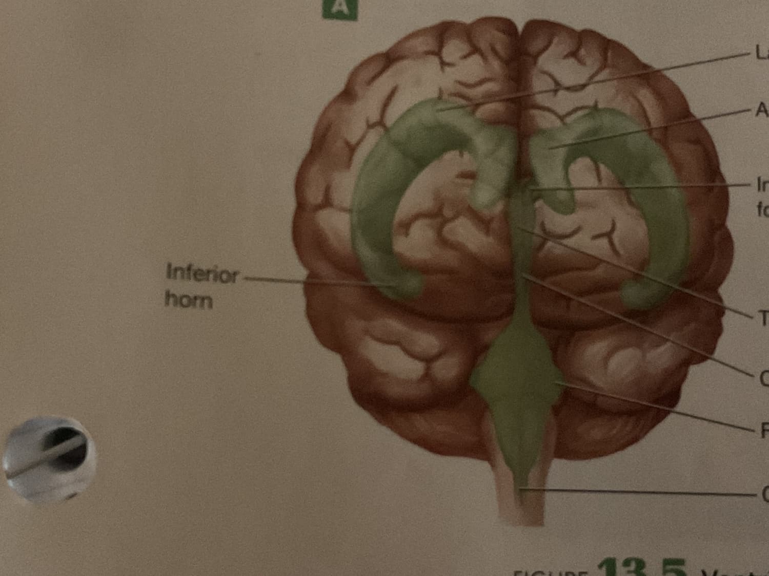 Anterior View Ventricles
